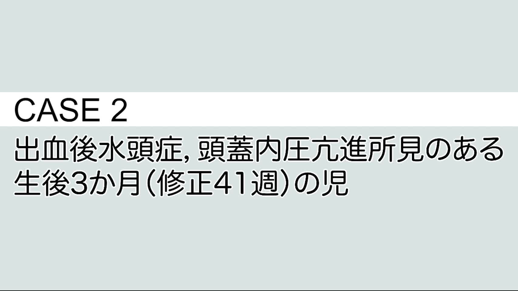 CASE② 出血後水頭症，頭蓋内圧亢進所見のある生後3か月（修正41週）の児...